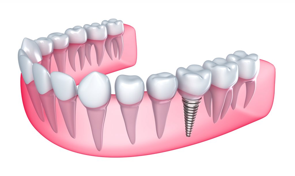 Implant dentar