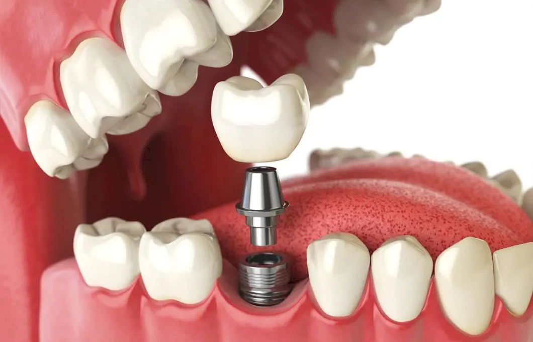 Ce este implantul dentar? Implante sau implanturi?