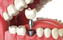 Ce este implantul dentar? Implante sau implanturi?