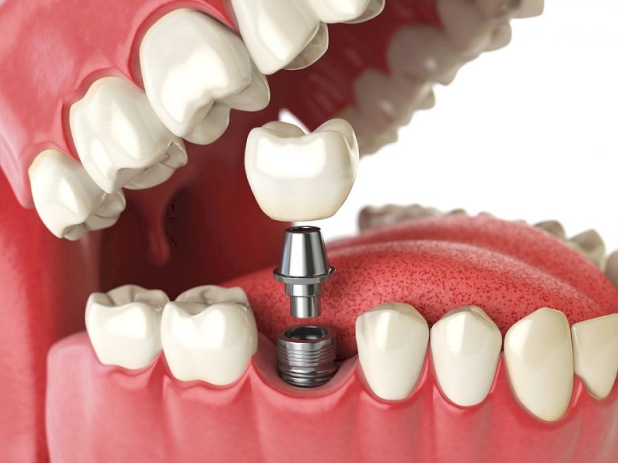 implant-Dental-co-136983479