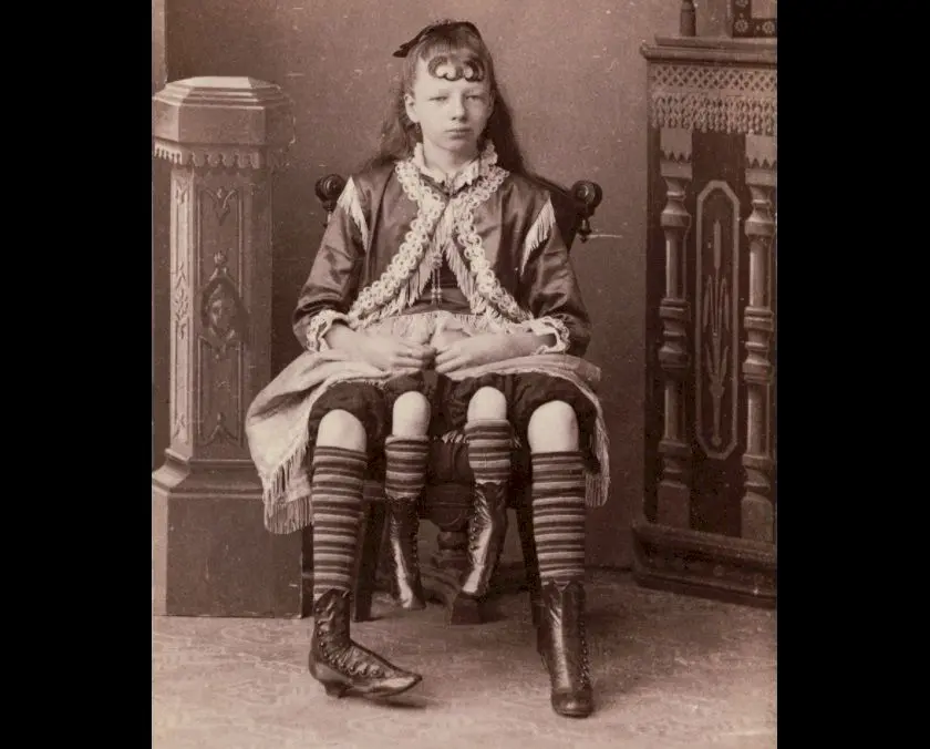 Care este povestea lui Myrtle Corbin, femeia cu patru picioare?