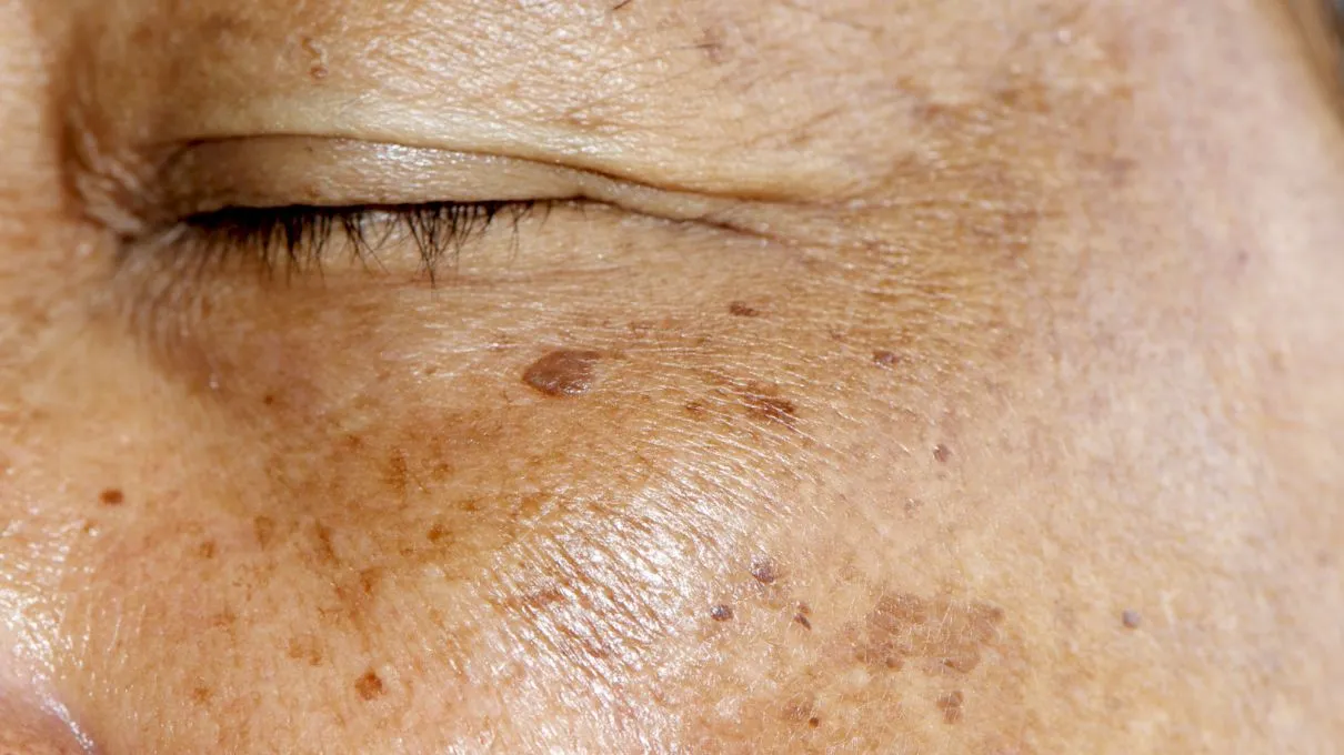 De ce apar pete pe piele la bătrânețe?
